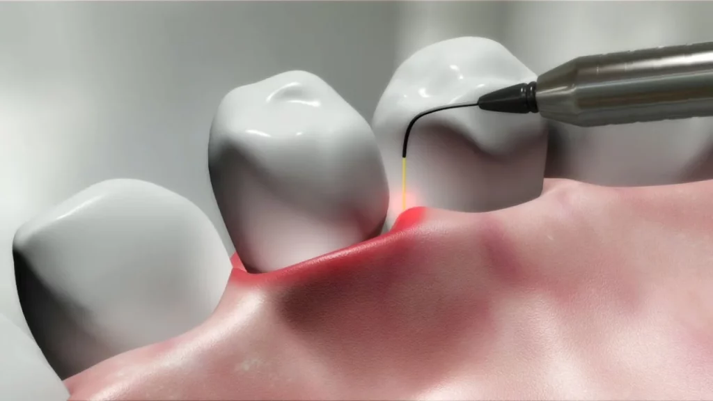 Удаление зубов лазером